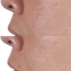 Тоник для лица с эффектом лифтинга Perricone MD High Potency Classics Face Finishing & Firming Toner, 118 мл